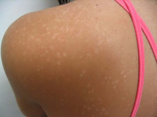 Tinea versicolor.