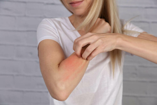Woman scratching red arm.