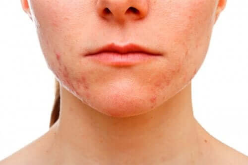 A woman with acne.