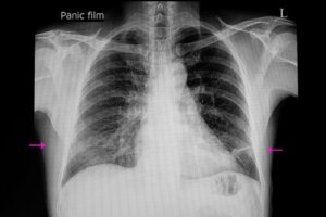 The Symptoms and Causes of Atelectasis