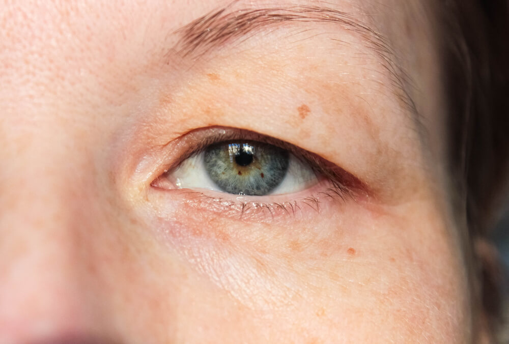 five-natural-remedies-to-lift-droopy-eyelids-step-to-health