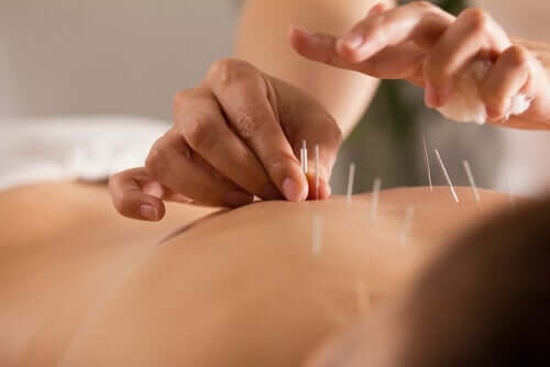 A person doing acupuncture.