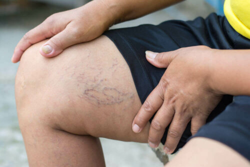 A person showing their varicose veins.