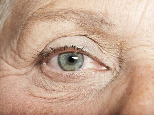 A person with eye freckles.