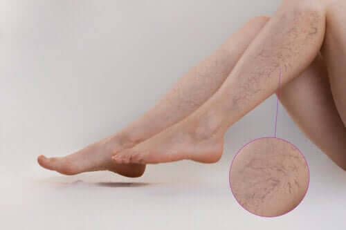 Types of Exercise to Prevent Varicose Veins