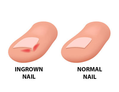 A toenail comparison.