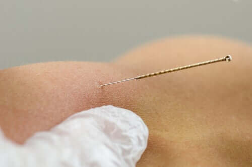 Dry Needling - Description and Benefits