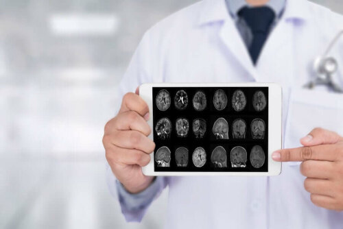 Doctor holding up tablet with images of brain scan on it.