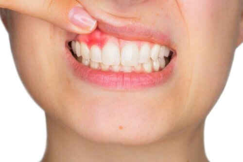 Gingivitis in gums, hyaluronic acid in dentistry can combat certain conditions.