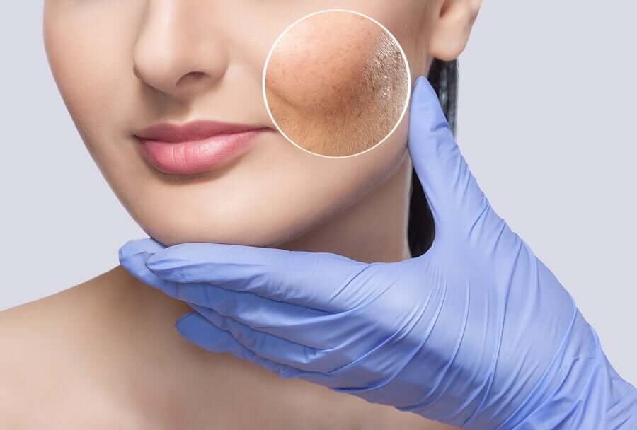 How to treat reactive skin.
