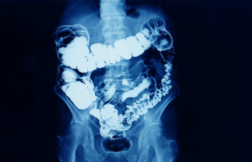 An x-ray showing inflamed colon, a possible side effect of excess glycerin suppositories.