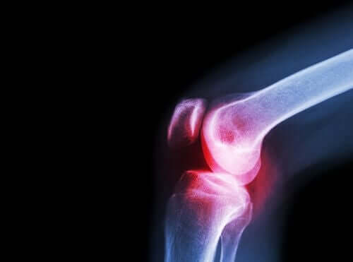 An X-ray showing joint pain, one of the symptoms of lupus.
