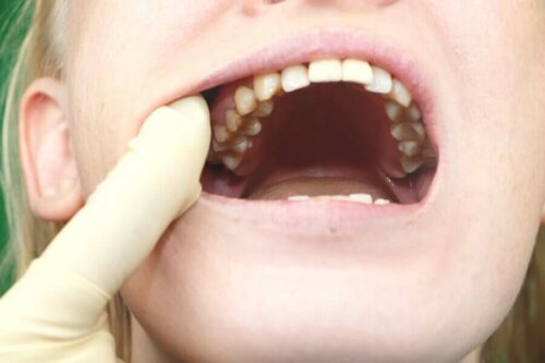 Patient with mouth open.