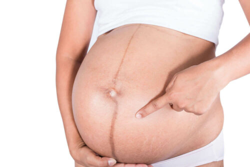 Pregnant woman pointing at stretch marks.