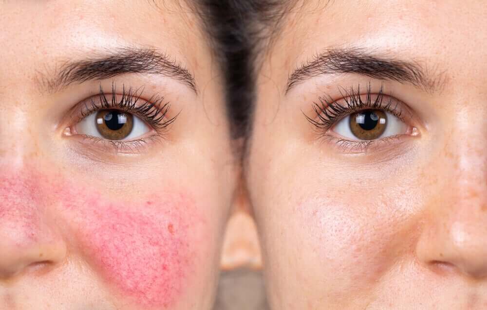 Relacorilant Rash Reactive Skin: Symptoms, Causes, and Treatment - Step To Health