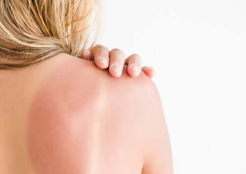 Solar Erythema: Recommendations and Care - Step To Health