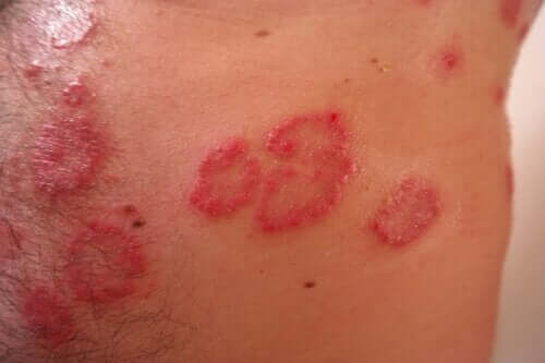 World Lupus Day: The Butterfly Rash Disease