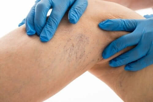 A leg with varicose veins.