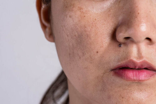 Woman with melasma on face, skin change due to pregnancy.
