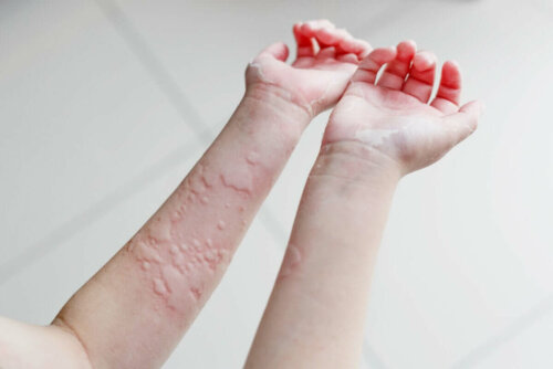 A person after scratching a rash.