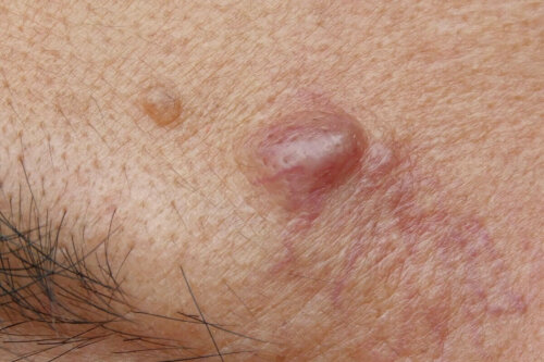 A person with cysts.