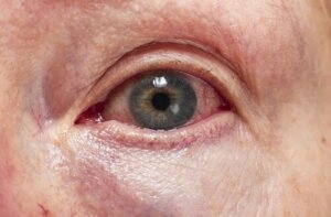 Diagnosis and Treatment of Uveitis