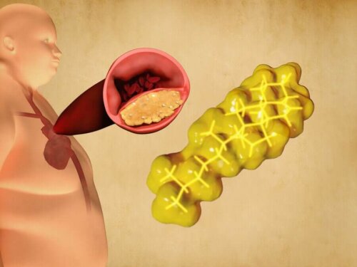 An obese person high in triglycerides.