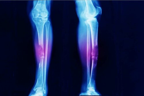 Zdjęcie rentgenowskie nogi. Rak kości. Mięsak