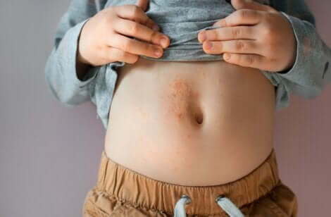 A child with atopic dermatitis.