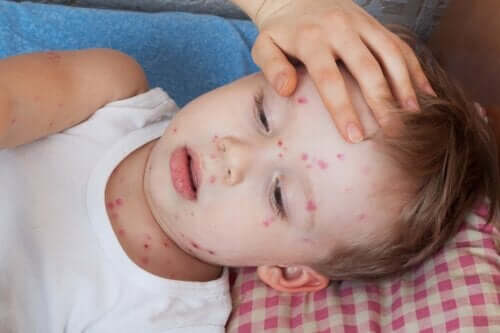 How to Treat Hives in Children
