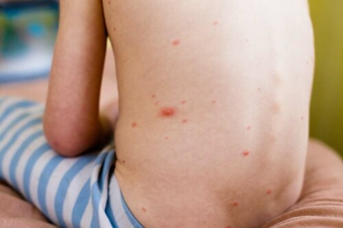 A child's back covered in hives.