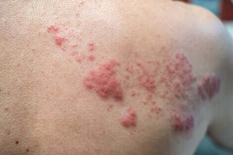 Shingles in a person's back.
