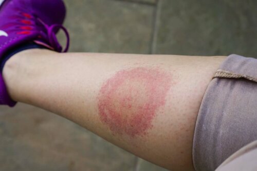 A tick bite on the leg.