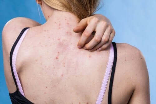 10 Causes and Types of Skin Rashes - Step To Health