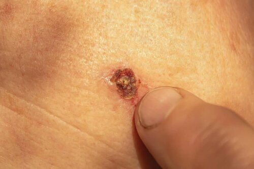 A bleeding wart.