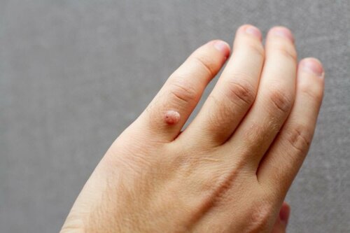 A wart on a person's finger.