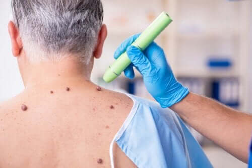 Why Warts Bleed