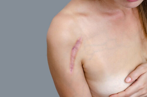 A woman with a scar on her shoulder.