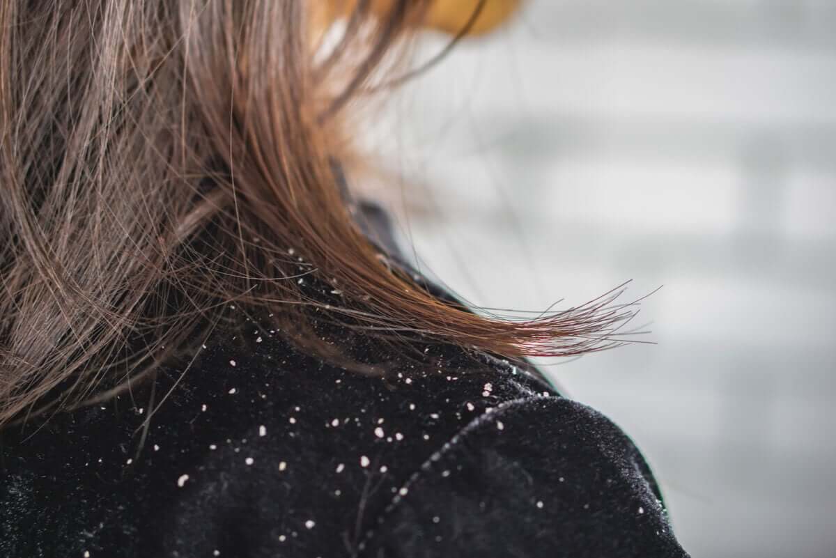A woman with dandruff.