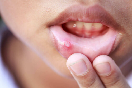 A child showing their cold sores.