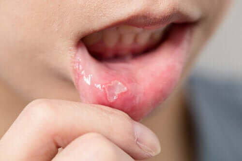 Treatment for Cold Sores in Children