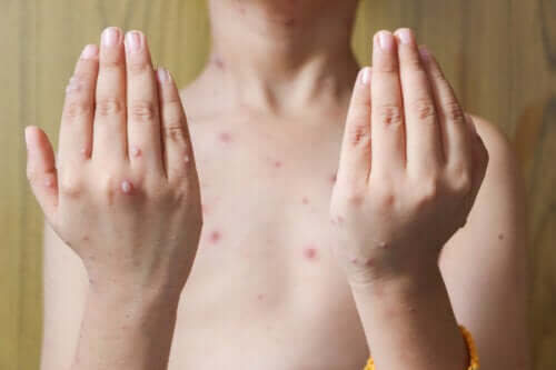 Symptoms and Treatment of Herpes Zoster in Children