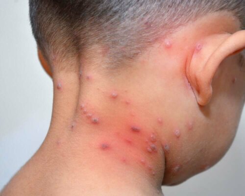A child with herpes.
