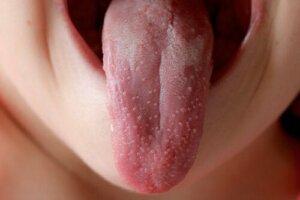 Is Scarlet Fever Contagious?