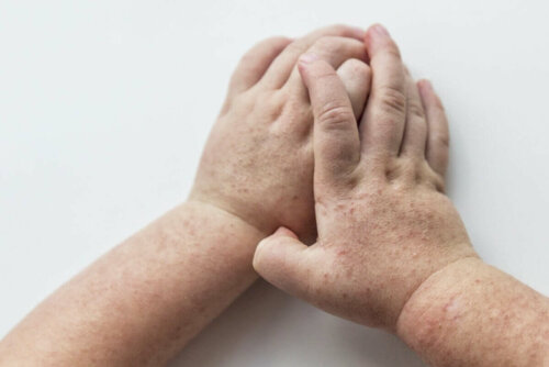 A pair of hands with a rash.