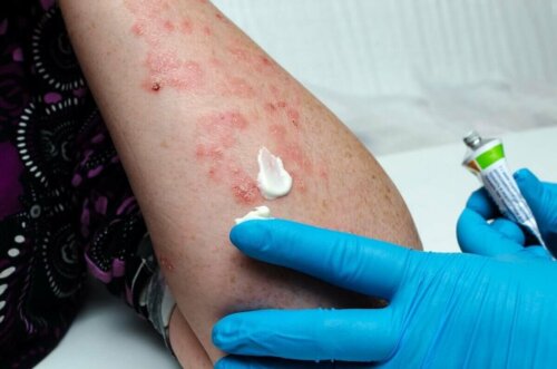 A person with a skin condition.