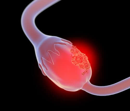 What Is Giant Mucinous Cystadenoma of the Ovary?