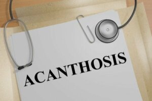 The Causes of Acanthosis Nigricans