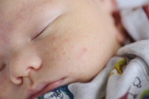 How to Treat Cradle Cap and Baby Acne