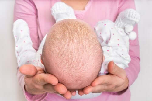 A baby with cradle cap.